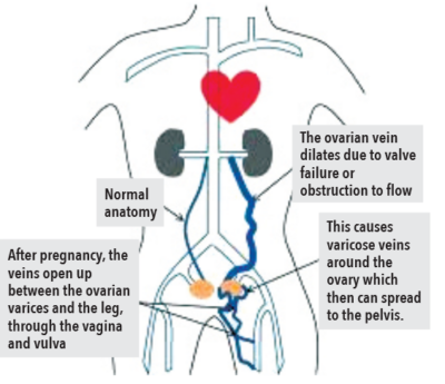 What Are Pelvic Labial Varicose Veins