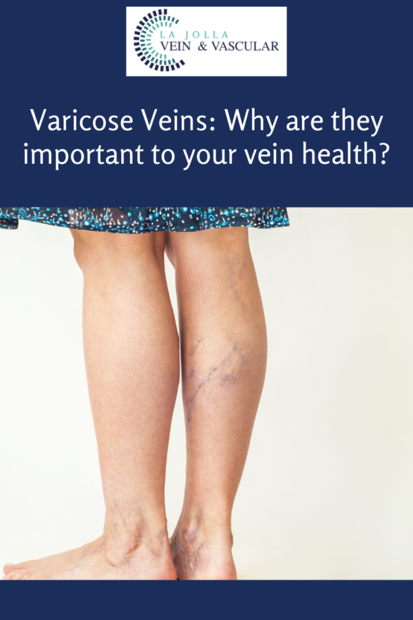 Vein Vascular Treatment Varicose Veins