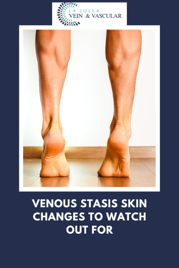 Vein Vascular Treatment Venous Stasis