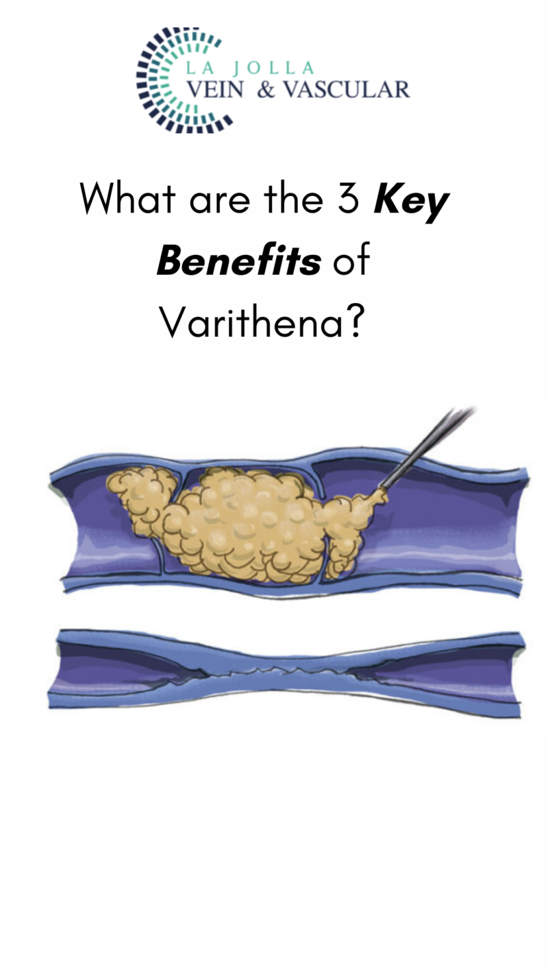 What You Need To Know About Varicoceles