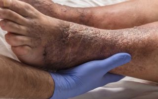 Complications of Untreated Varicose Veins #2 Cellulitis