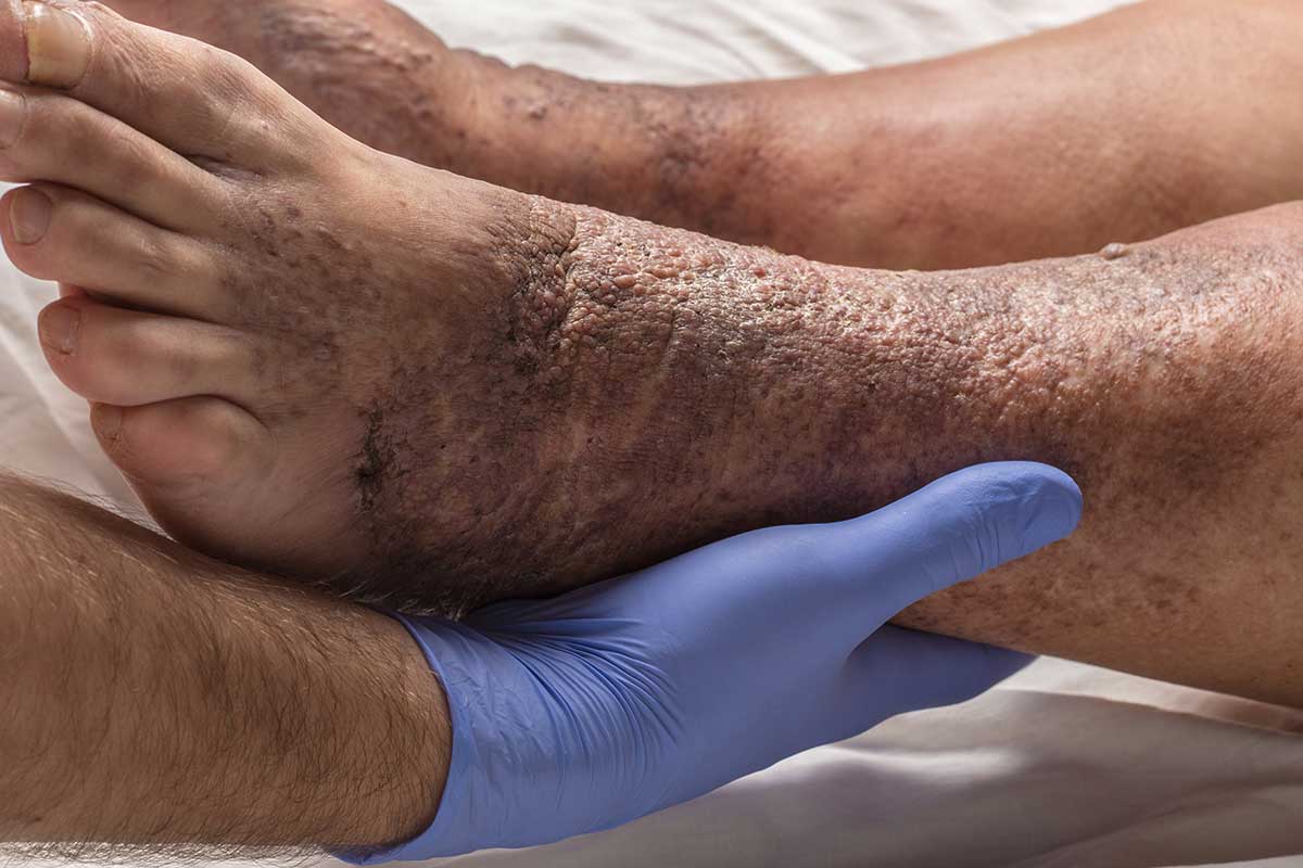 Complications of Untreated Varicose Veins #2 Cellulitis