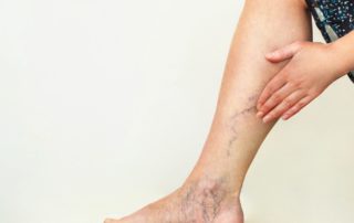 Complications of Varicose Veins