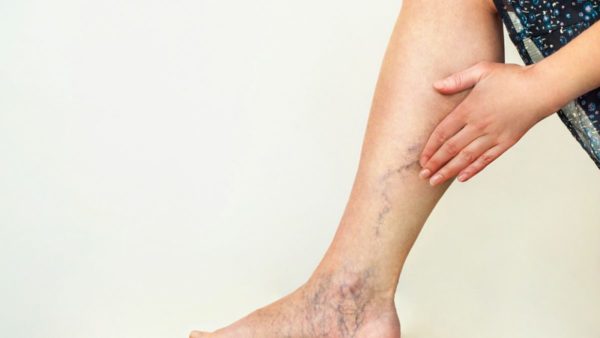 Complications of Varicose Veins #6: Darkening of the Skin