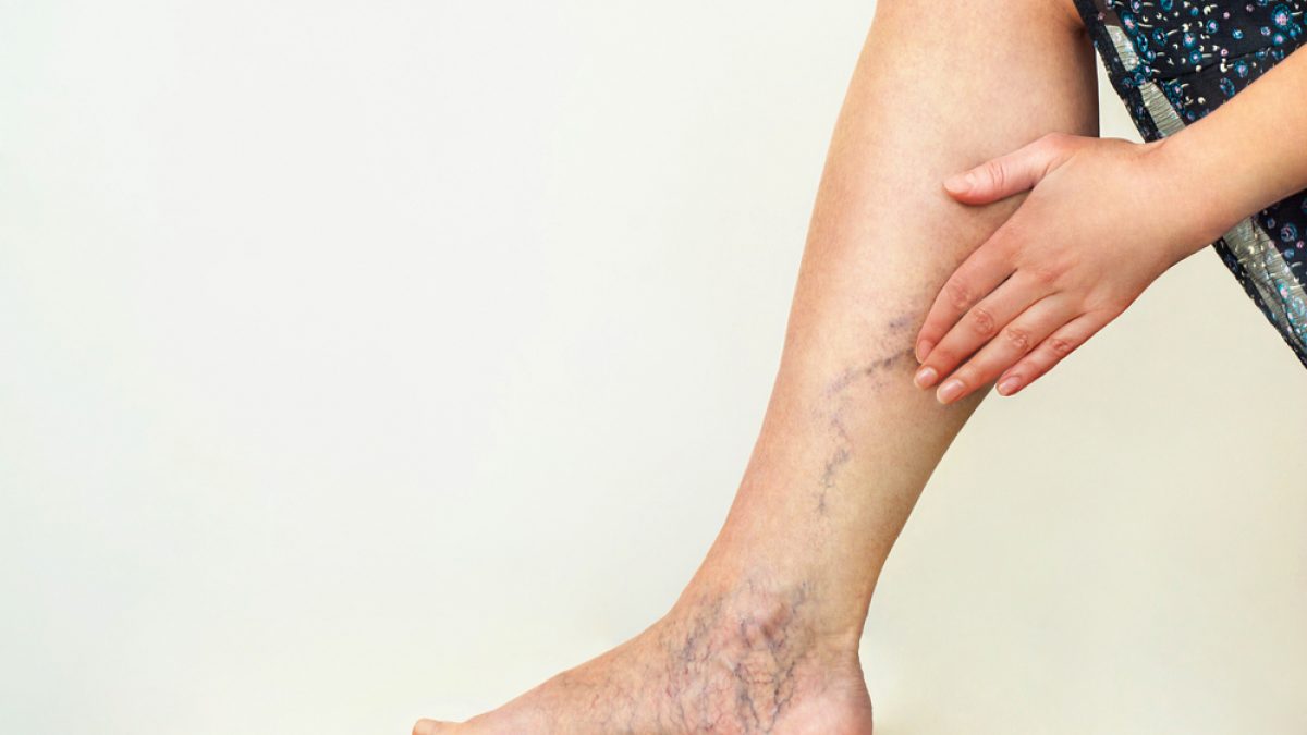 Why Am I Always Propping My Legs Up?: Vascular Solutions: Vein