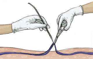 Micro-Phlebectomy to Remove Varicose Veins 6 Illustration of a micro-phlebectomy