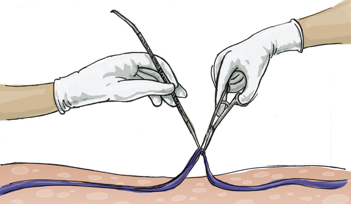 Illustration of a micro-phlebectomy