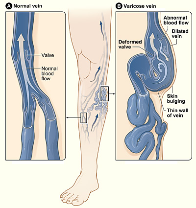 Diagram showing the details of Varicose veins