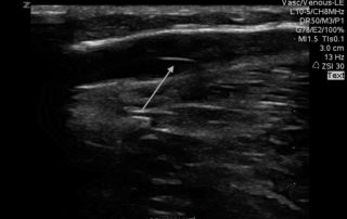 vein valve