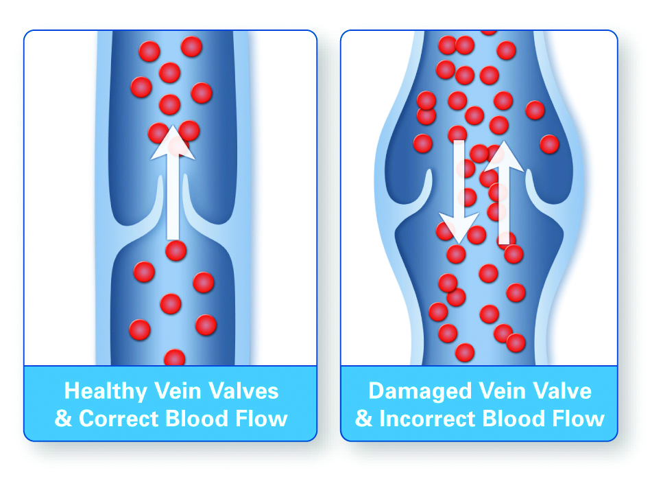 healthy_and_diseased_valves