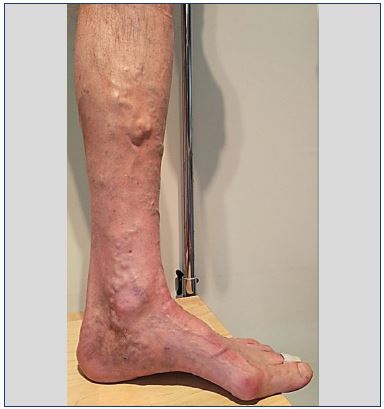 Duplex ultrasound of the leg veins