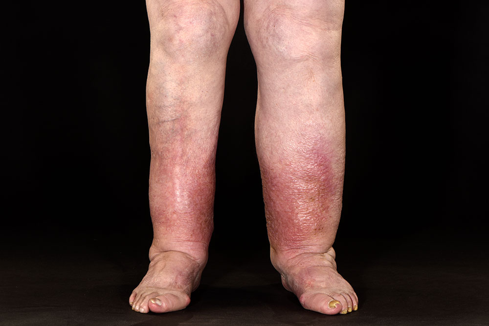 Leg swelling from varicose veins