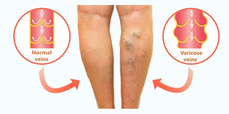 Leaky Vein Valve Disease and Varicose Veins
