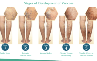 Stages of Venous Disease