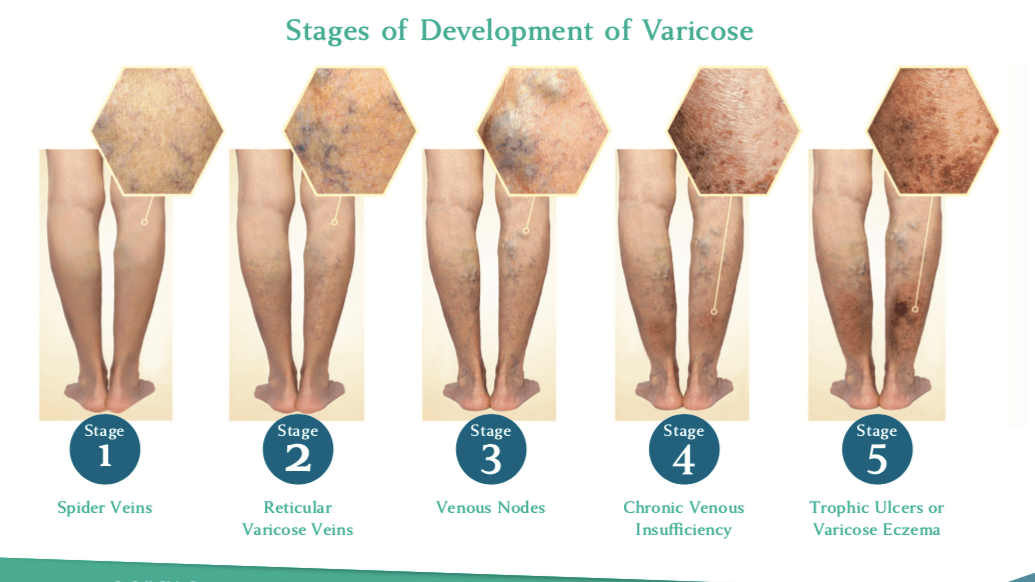 Venous Reflux Disease, Chronic Venous Insufficiency Stages