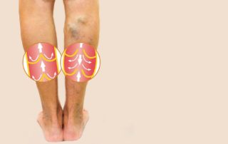 varicose-vein-valve-image-on-legs