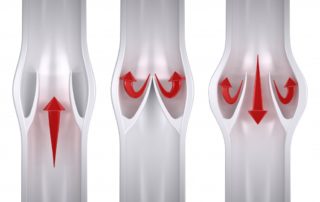 Leaky Valves In Legs