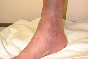 What your skin says about your vascular health 8 photo of venous leg ulcers