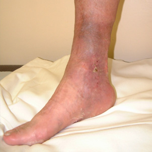 Stage 6. Venous eczema and venous leg ulcer