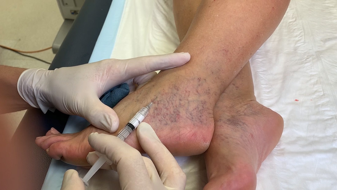 The ultrasound-guided foam sclerotherapy procedure