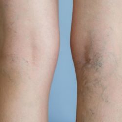 Varicose veins must cause leg pain or other symptoms
