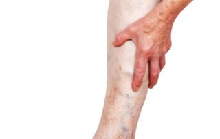 Spider Veins Along the Ankle Indicate Underlying Reflux Disease 1 image of corona phlebectasia