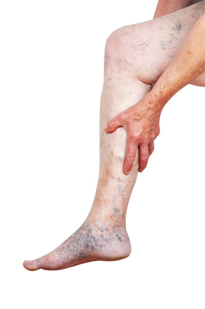 Spider Veins Along the Ankle Indicate Underlying Reflux Disease