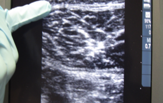 Foam Treatment for Varicose Veins Is Not New 7 Foamed sclerosant inside a vein: Once foam is introduced into the vein, it is hyperechogenic on ultrasound. In this picture taken in 2009, Dr. Bunke points to the foamed medication inside the vein. Notice it appears ‘white