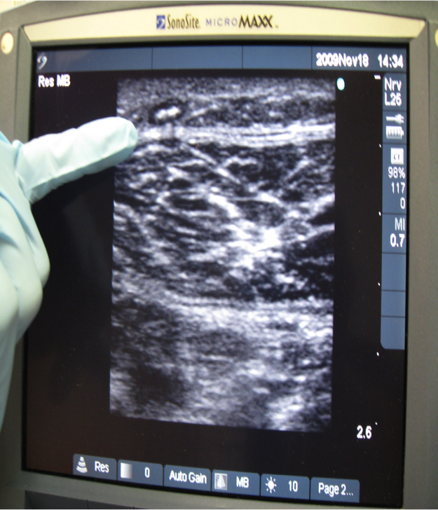 Foamed sclerosant inside a vein: Once foam is introduced into the vein, it is hyperechogenic on ultrasound. In this picture taken in 2009, Dr. Bunke points to the foamed medication inside the vein. Notice it appears ‘white