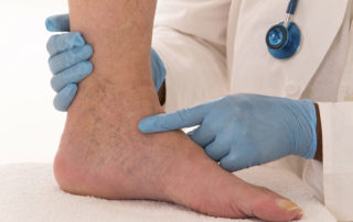 Understanding Insurance Coverage for Varicose Veins