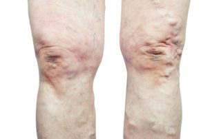 varicose veins & spider veins