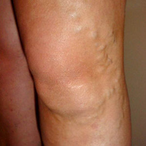 image of varicose veins
