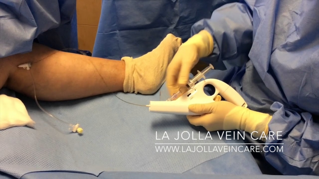 New Varicose Vein Treatments 2014: Clarivein 1 Clarivein insertion