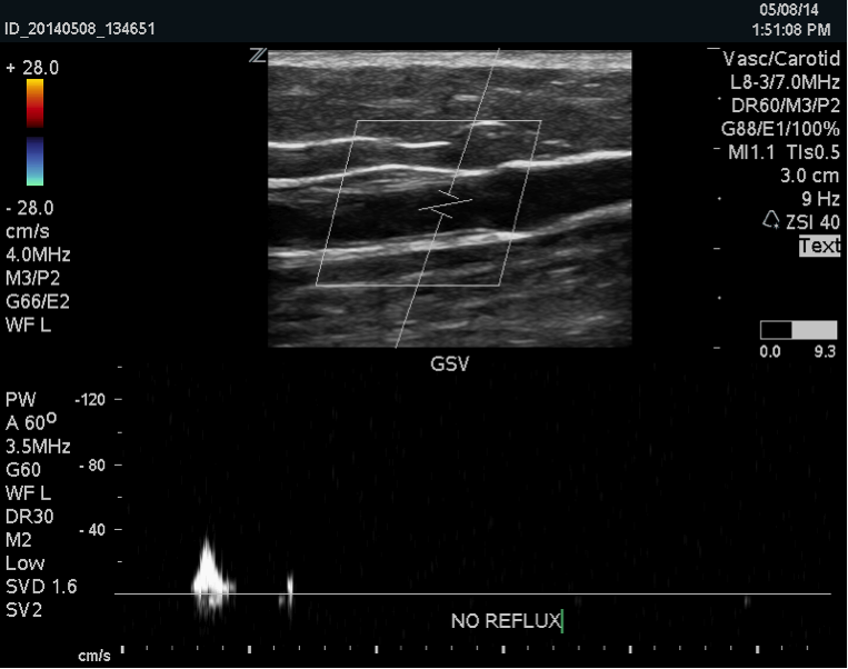 What If I need my Great Saphenous Vein for Bypass Someday? 2 GSV1
