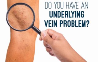 Underlying Vein Problem ,Varicose veins may be present long before you see them