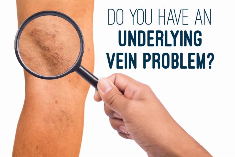Underlying Vein Problem ,Varicose veins may be present long before you see them