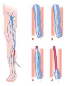 Diagram of endovenous laser ablation (EVLA) procedure