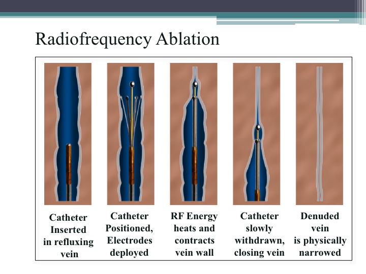 Radiofrequency Technology: The Next Wave for Treating Varicose Veins 2 This is another picture, of before and after treatment with radiofrequency ablation in combination with foam sclerotherapy at La Jolla Vein Care.