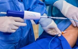 Do I Need Surgery for Varicose Veins? 3 VenaSealproceedure