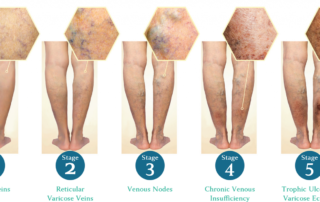 Image Showing Stages of Development of Varicose