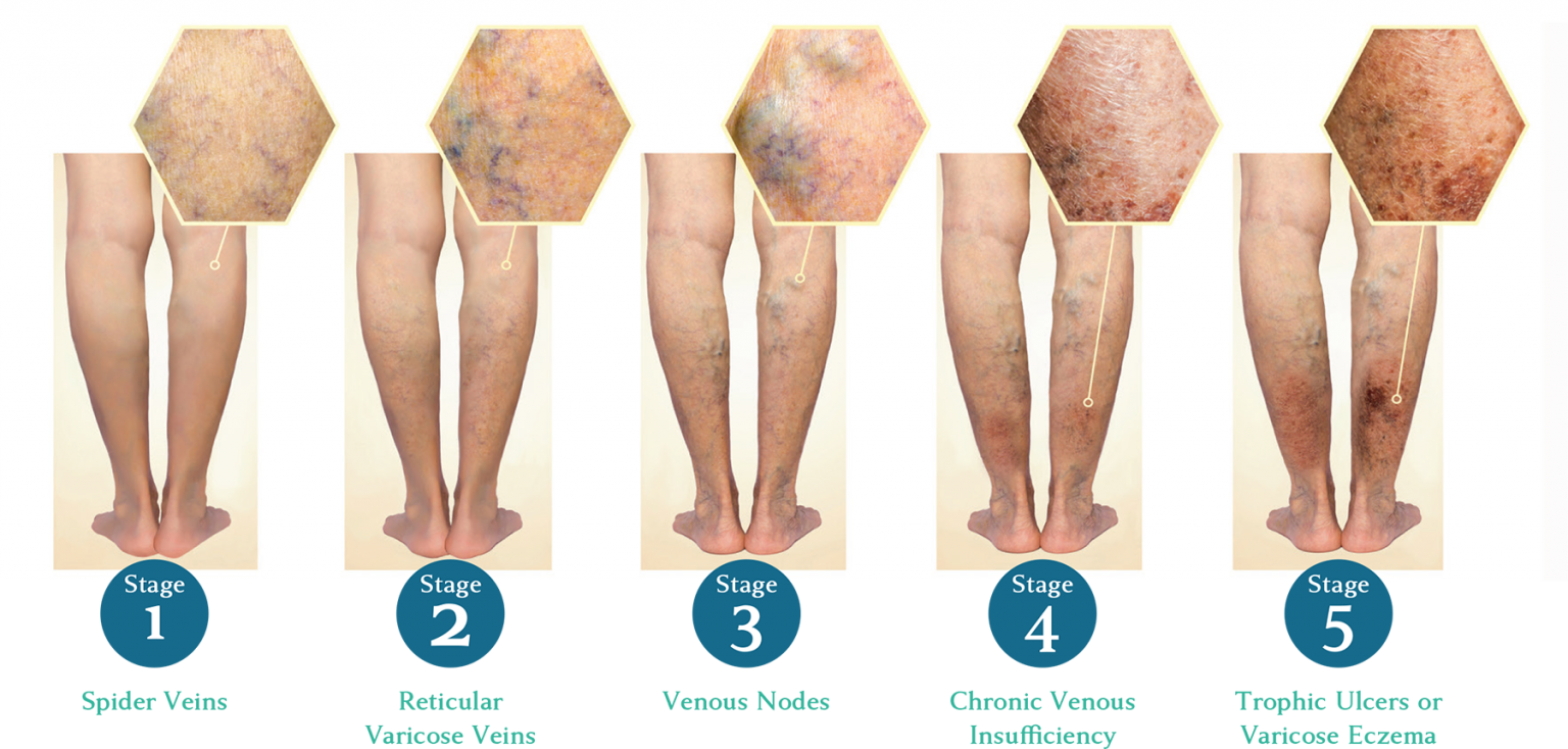 Image Showing Stages of Development of Varicose