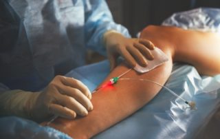 Endovenous laser vein ablation therapy (EVLT) uses a tiny catheter to seal incompetent veins shut.