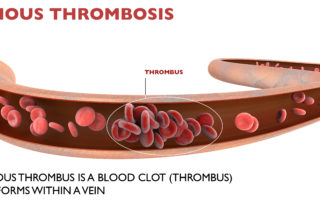 Johnson and Johnson Vaccine and Deep Venous Thrombosis