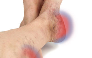 How to Manage Varicose Vein Pain at Home 7 leg pain-small