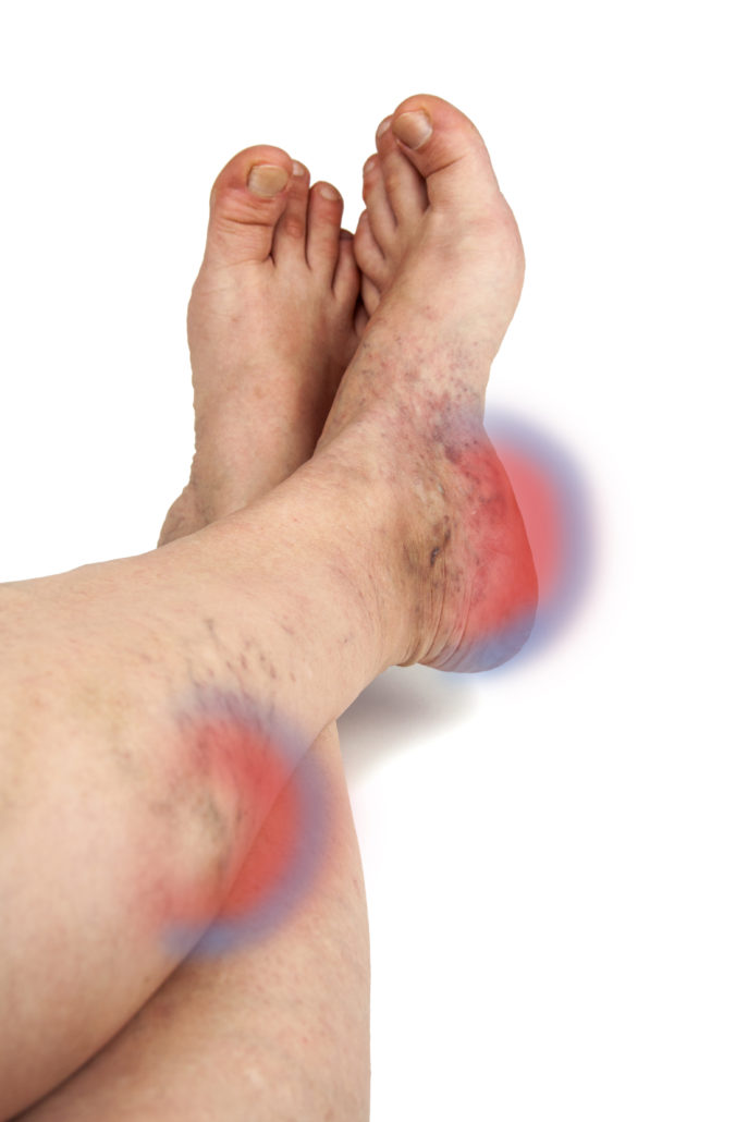 How to Manage Varicose Vein Pain at Home