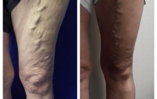 mom : daughter inherited varicose veins