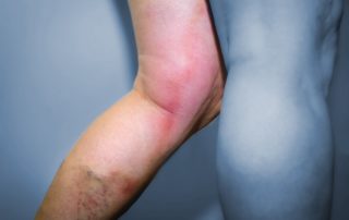 Thrombophlebitis