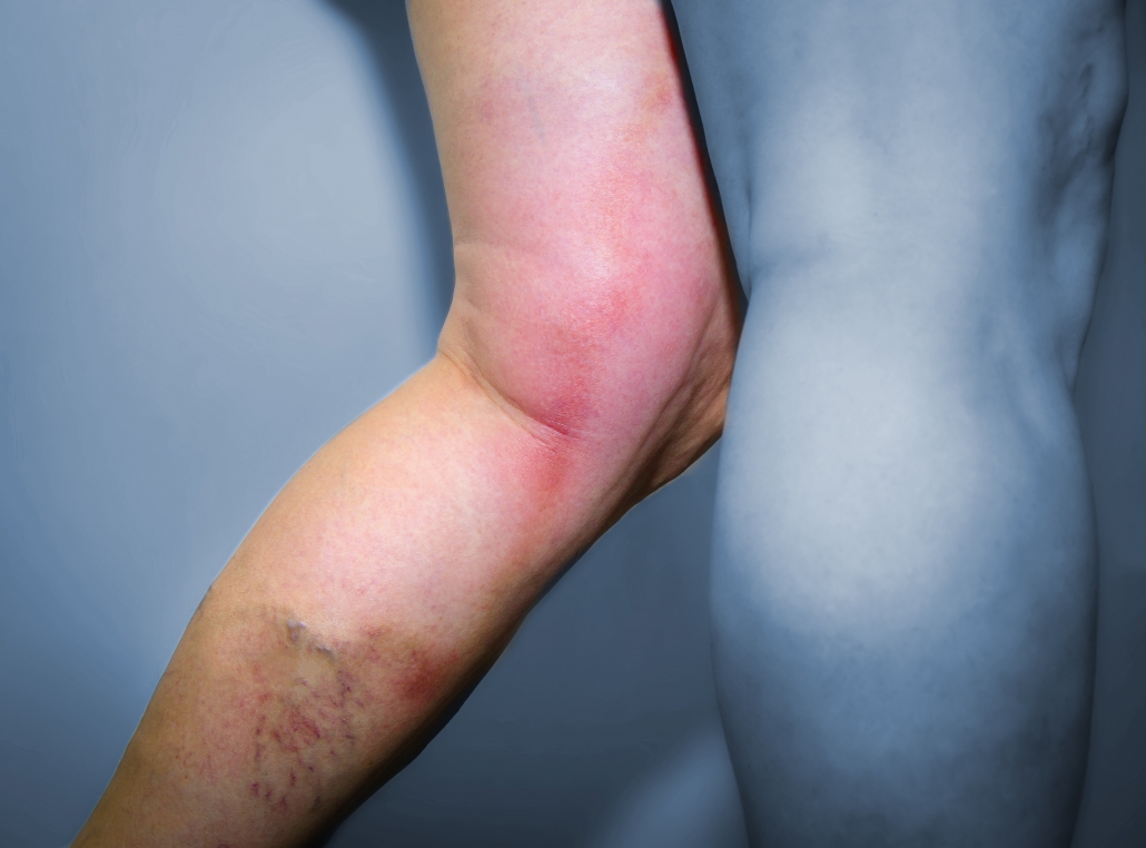Deep Vein Thrombosis and Thrombophlebitis, Services