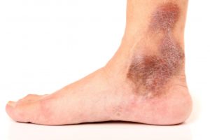 Darkening of skin, and itchiness are a sign of chronic venous insufficiency or venous reflux disease