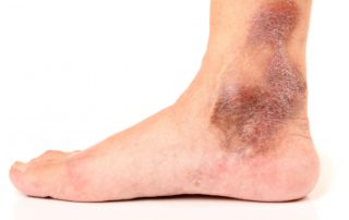Darkening of skin, and itchiness are a sign of chronic venous insufficiency or venous reflux disease